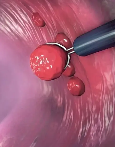 Хронічний ендометрит: <br> <span class='text-primary-400 font-bold text-3xl  lg:text-5xl xl:text-6xl'>прихована причина безпліддя</span>