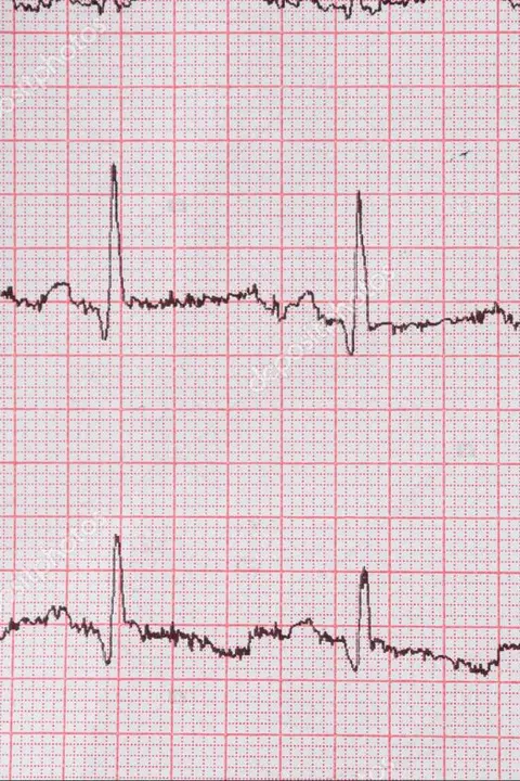 Электрокардиограмма (ЭКГ): <br> <span class='text-primary-400 font-bold text-3xl  lg:text-5xl xl:text-6xl'>ключ к здоровью вашего сердца</span>