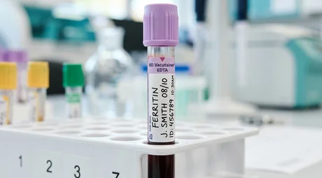 Дефицит железа у женщин: роль ферритина и симптомы