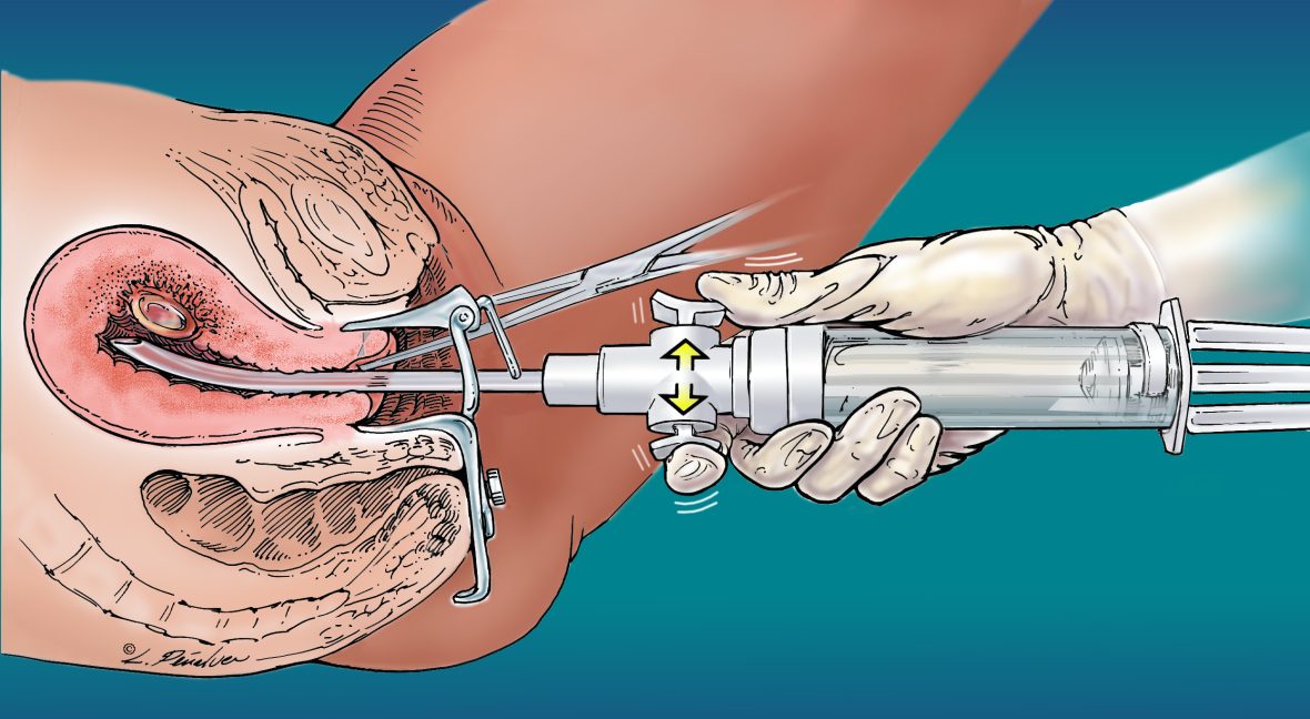1-biopsiya