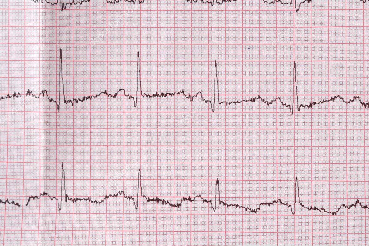 Heart electrocardiogram EKG chart on special paper. Concept for heart scan, health insurance, medical background, examination