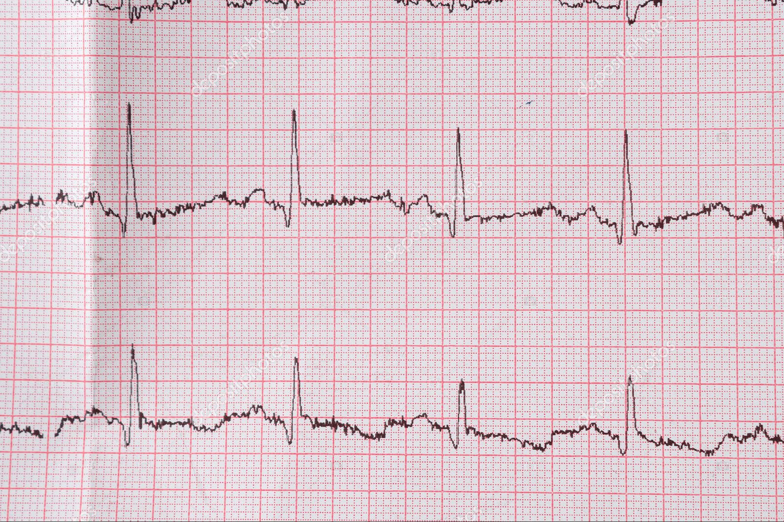 Heart electrocardiogram EKG chart on special paper. Concept for heart scan, health insurance, medical background, examination